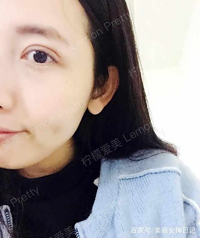 学妹做全切双眼皮 开眼角1个月后问:平行扇形双眼皮是这样的吗?