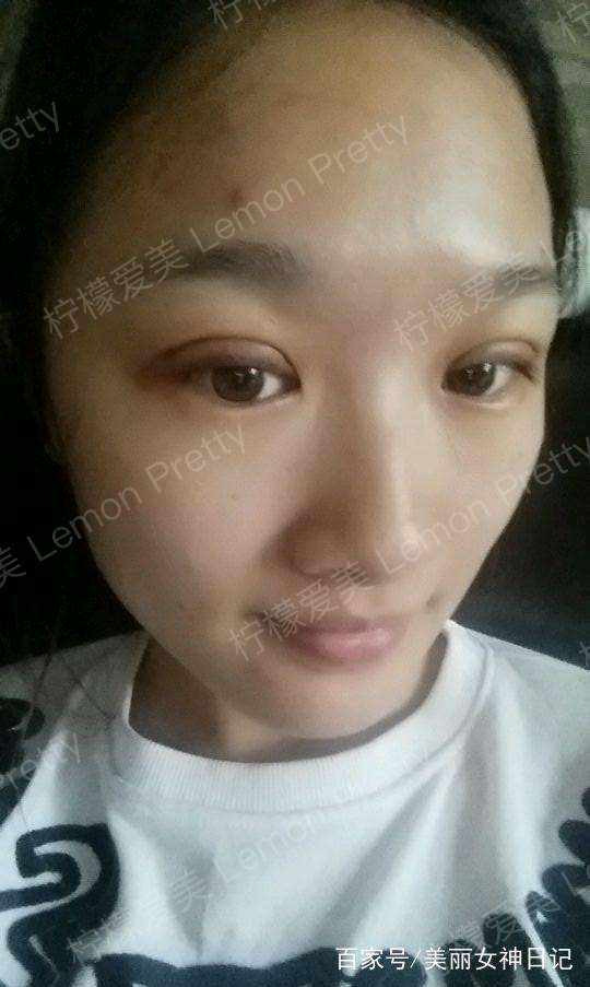学生妹做埋线双眼皮1个月后,画了眼妆,涂了口红,看着很妖艳!