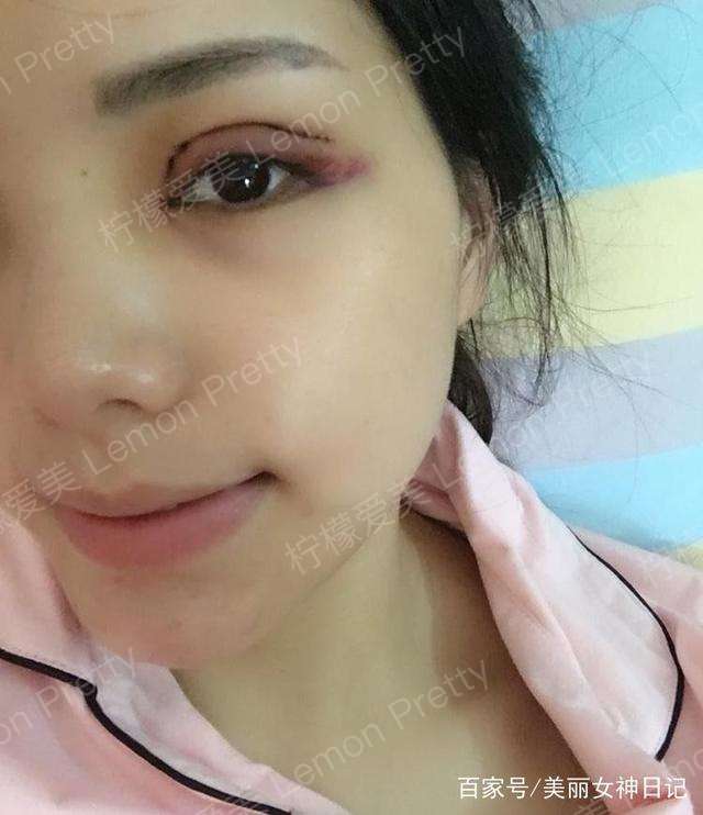 女销售做全切双眼皮 开眼角2个月后说:明显比没做之前漂亮!哈哈