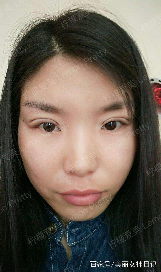 大二女生双眼皮埋线1个月后,后悔没抽脂,这大小眼怎么见人啊!