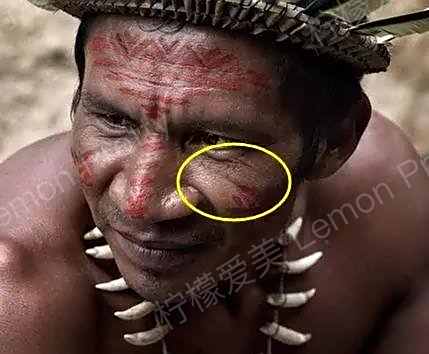 为什么打了满脸的玻尿酸,还能看到印第安纹!