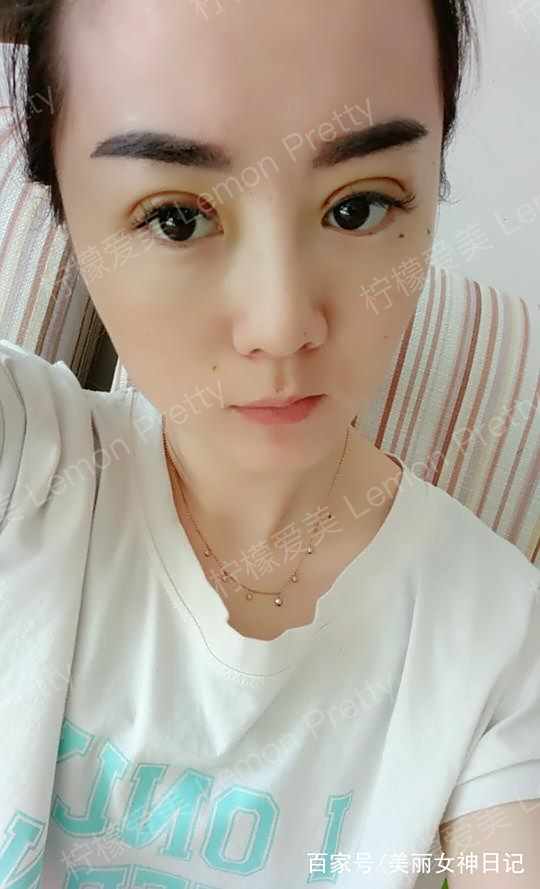 小姐姐做"双眼皮埋线8mm"1个月后问:是不是做的太宽了!咋办?