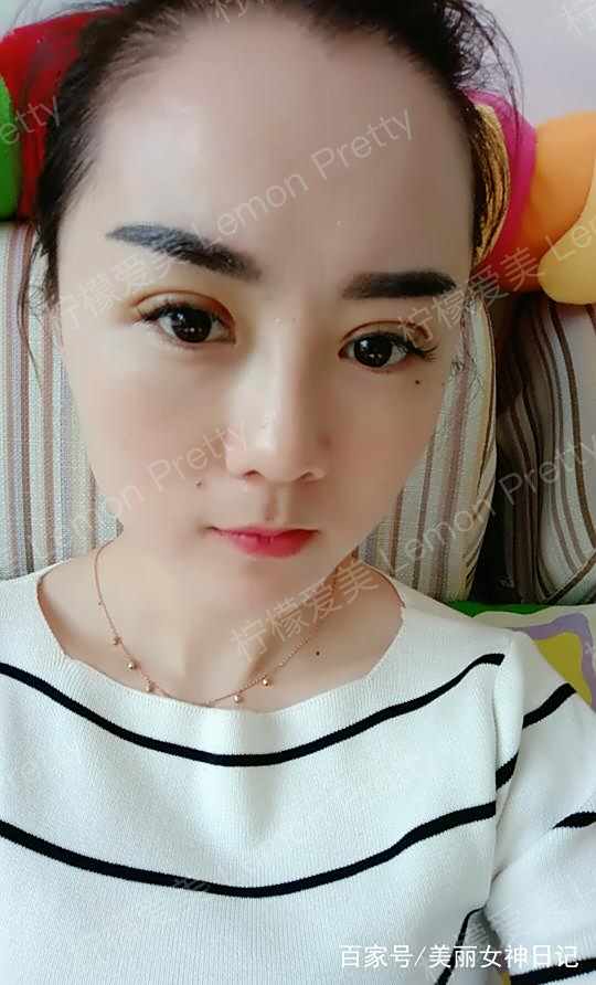 小姐姐做"双眼皮埋线8mm"1个月后问:是不是做的太宽了!咋办?