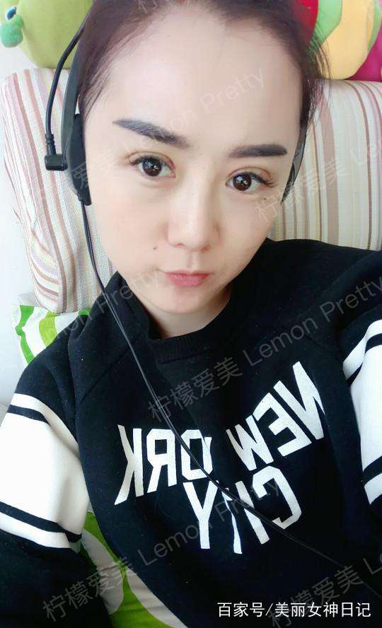 小姐姐做"双眼皮埋线8mm"1个月后问:是不是做的太宽了!咋办?