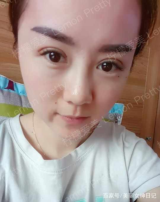 小姐姐做"双眼皮埋线8mm"1个月后问:是不是做的太宽了!咋办?