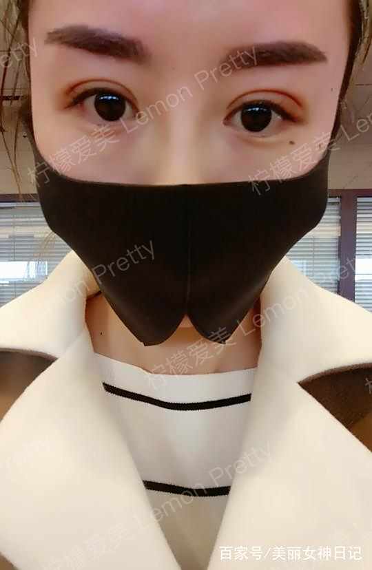 小姐姐做"双眼皮埋线8mm"1个月后问:是不是做的太宽了!咋办?