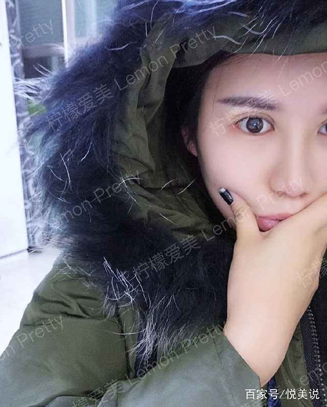 女白领做"切开双眼皮10mm 开眼角"四个月后说:双眼皮做宽了!