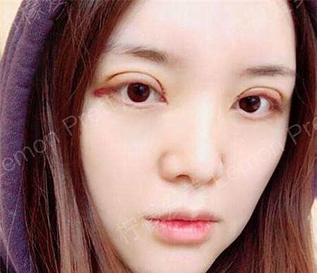 原本三角眼的我做了双眼皮手术后 眼睛变得明亮又靓丽