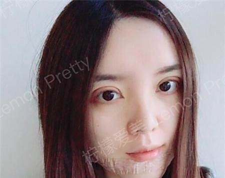 原本三角眼的我做了双眼皮手术后 眼睛变得明亮又靓丽