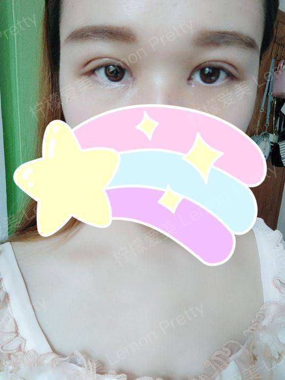 靠7cm宽的双眼皮上了头条!还担心太窄?