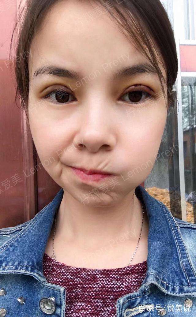 妹子偷偷的做全切双眼皮1个月后,闺蜜见了说她添了几分气质