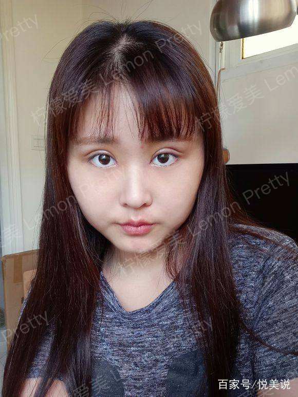女学生做"全切双眼皮7mm 开眼角"后应验了一句俗话,要想美