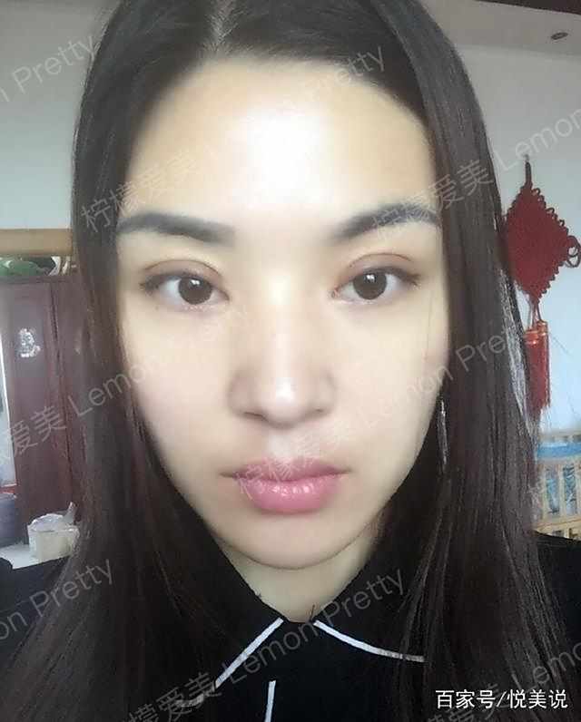 女店长做"全切双眼皮7mm"1个月后说:闺蜜夸她气质升级啦