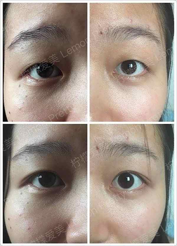 割之前眼睛是下垂的,看起来很没精神,还有点三角眼,肉眦赘皮也很严重