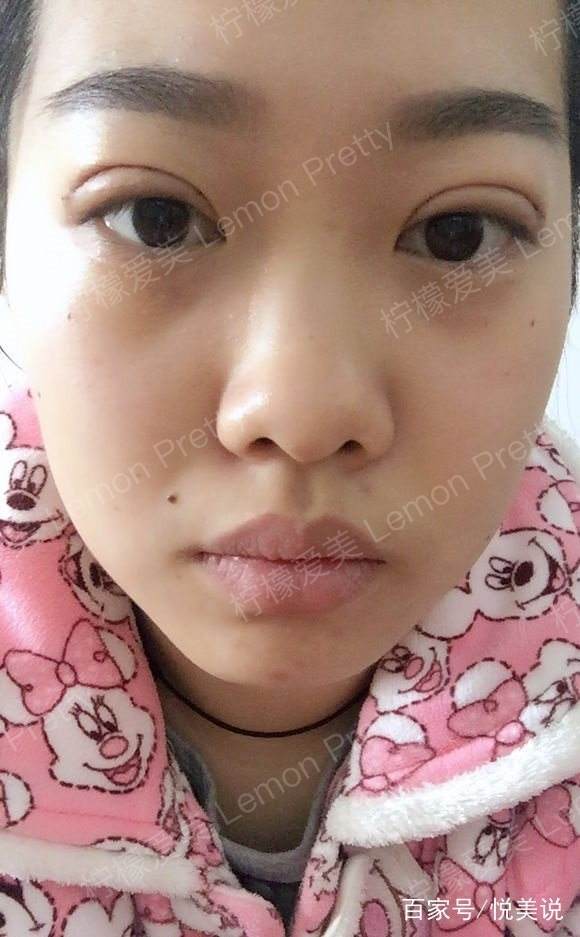 全切双眼皮 去脂肪20天后肿眼泡妹子问:是肿胀还是上眼皮下垂?