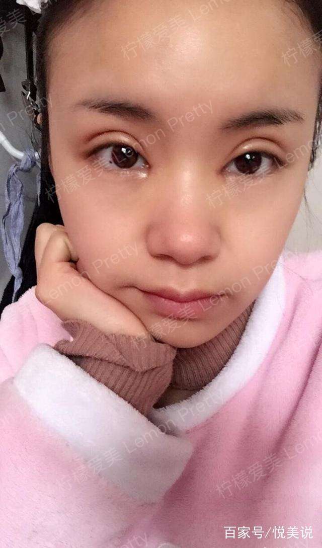 双眼皮13天了,还是有点肿,恢复怎么样