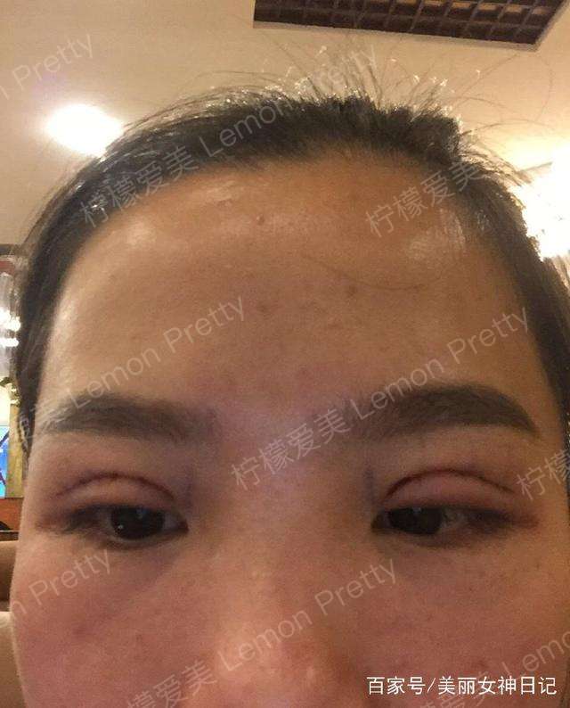 女店长做"埋线双眼皮"1个月后分享:害怕过两年就变"内双"了!