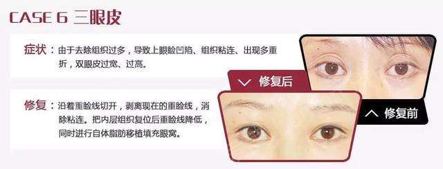 双眼皮失败是什么样子的 最佳修复时间是多久?