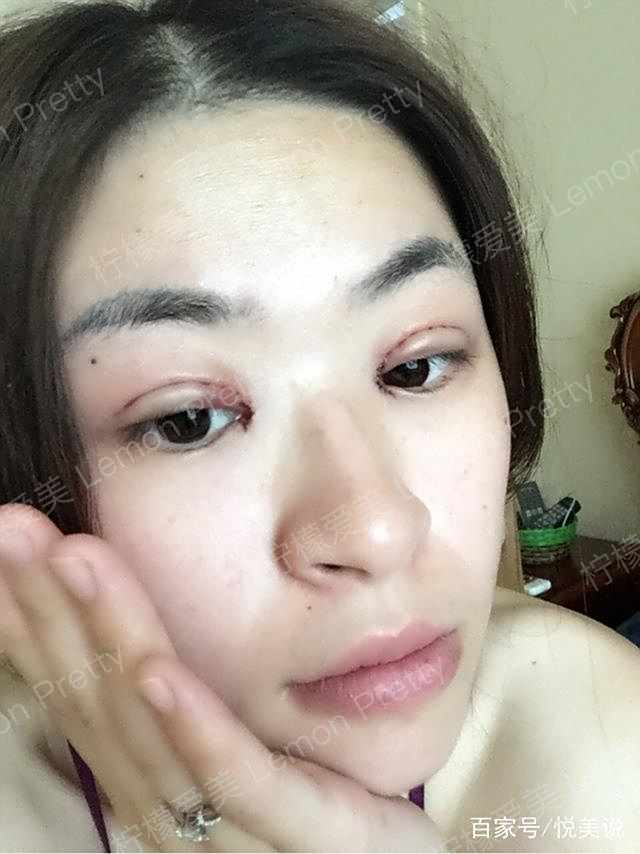 辣妈做"全切双眼皮 开眼角"2月后说:画了下眼妆,感觉美美哒!