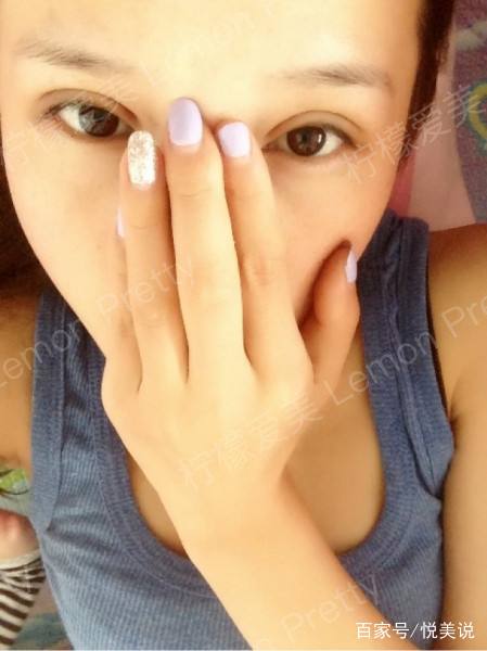 做过"埋线双眼皮"2个月后的女生问:眼皮一边宽一边窄怎么办?