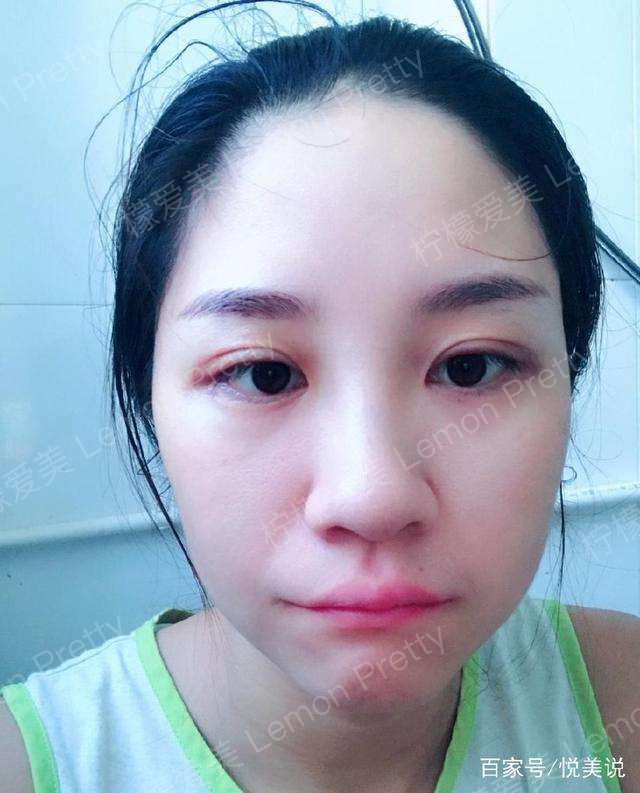 大姐姐做全切双眼皮 开眼角半月后说:哎!看起来比之前"显老"
