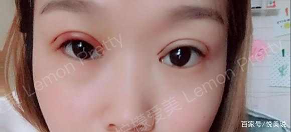 做"埋线双眼皮8mm"3个月后闺蜜见了说我:变得即成熟又有气质!
