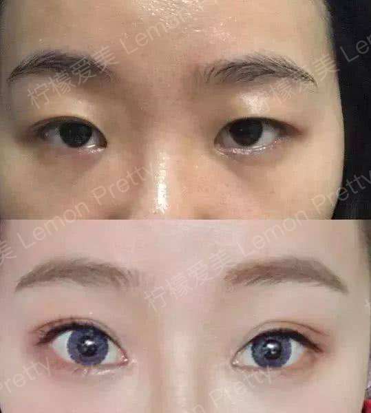 死鱼眼单身姑娘趁假期割了双眼皮,瞬间变电眼,好看死了!