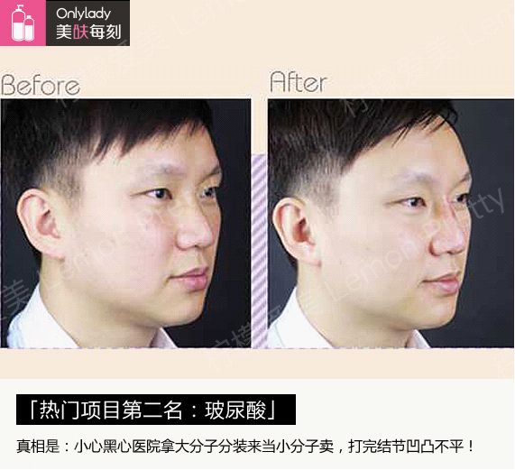 瘦脸针玻尿酸真的不能随便打,后果很严重!