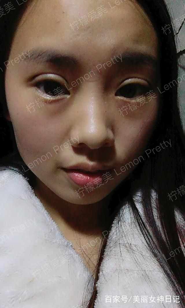女学生做埋线双眼皮1个月后问:画了眼妆,双眼皮看起来不假吧?