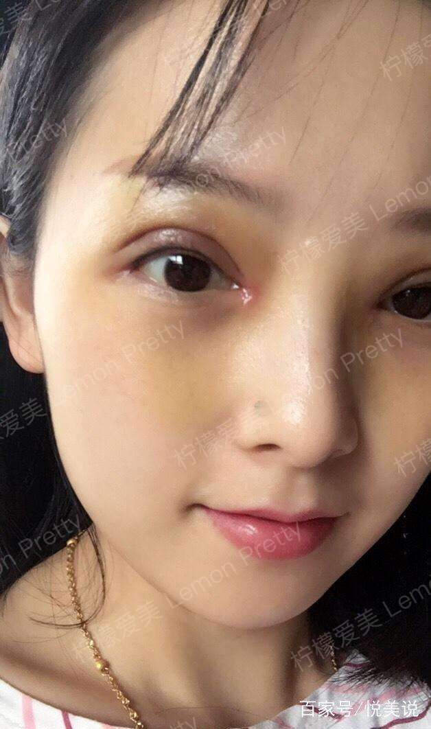 妹子做全切双眼皮 开眼角后说:画了眼线,基本看不出来是假的