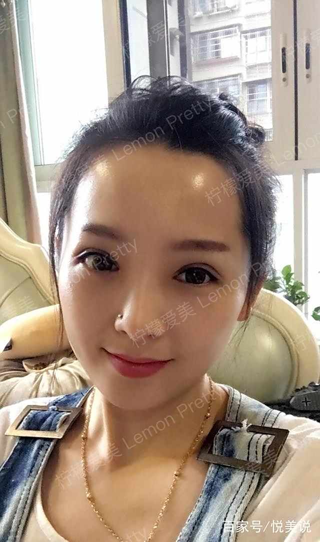 妹子做全切双眼皮 开眼角后说:画了眼线,基本看不出来是假的