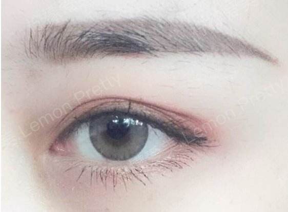 做的明明是双眼皮手术为什么恢复后成了三眼皮了