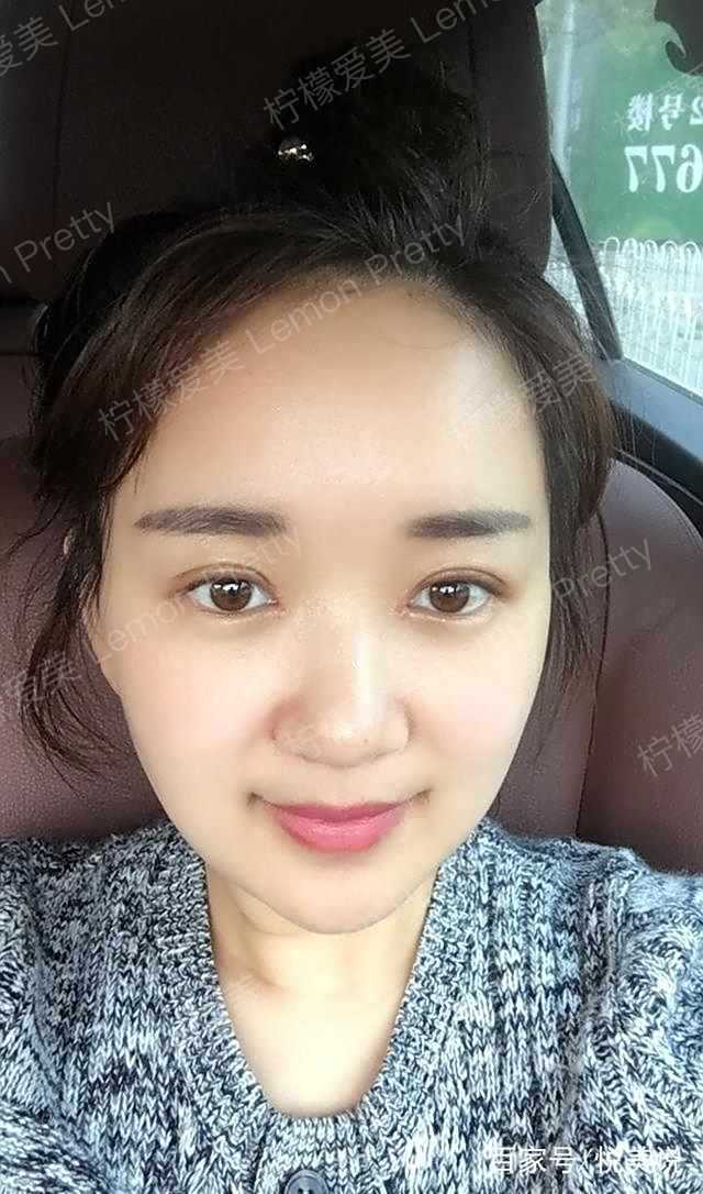 做全切双眼皮 开眼角2个月后,闺蜜说我的双眼皮看起来很自然了!