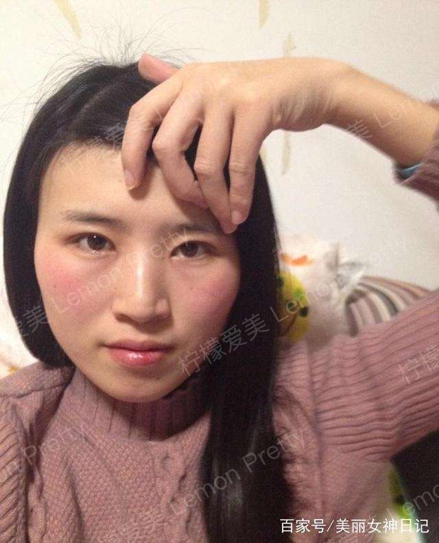 这个宝妈做的"全切双眼皮 开眼角":割成"大小眼"了!咋办?