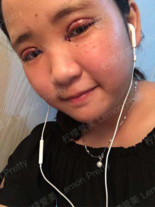 闺蜜做完"全切双眼皮7mm 开眼角"后,朋友们都劝我去做啊!