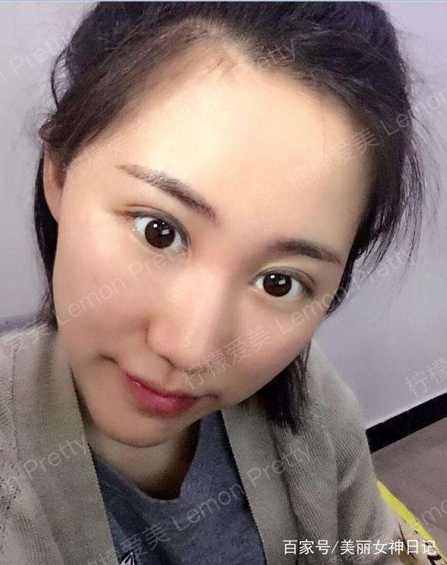 女销售做"双眼皮埋线"1个月后说:画条眼线,看着"显成熟"!