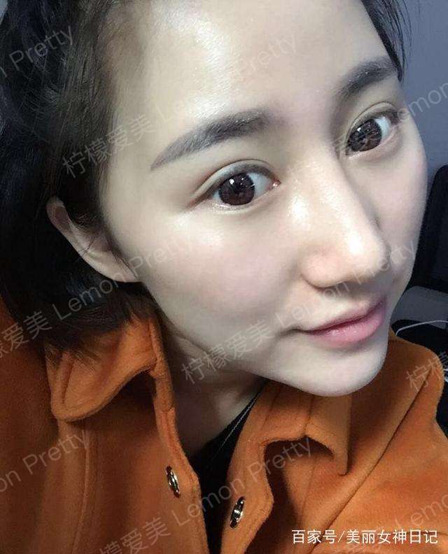 女销售做"双眼皮埋线"1个月后说:画条眼线,看着"显成熟"!