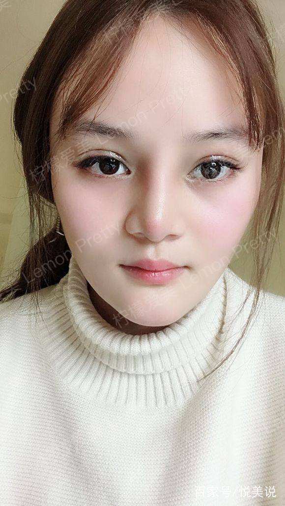 大一妹子做了"埋线双眼皮 纹美瞳线"后说:都说我越来越萌了