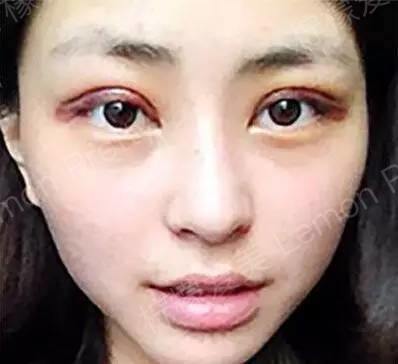 埋线双眼皮半年,看看那些照片,简直像换了个人