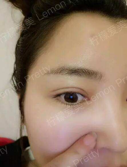 做了双眼皮手术后,观察一个月,发现周围的人都说我逆袭像女神