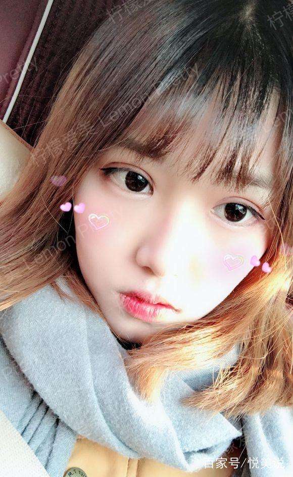 大三女生全切双眼皮 去眼袋后说:终于变成大眼睛双眼皮萌妹子了