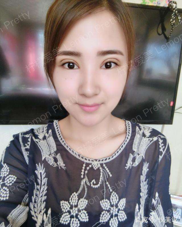 大四女孩做"全切双眼皮7mm"后,同事们都夸她现在颜值升高了!