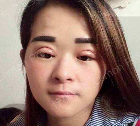花了大价钱忍痛做的双眼皮,现在该不该后悔?割完也太夸张了