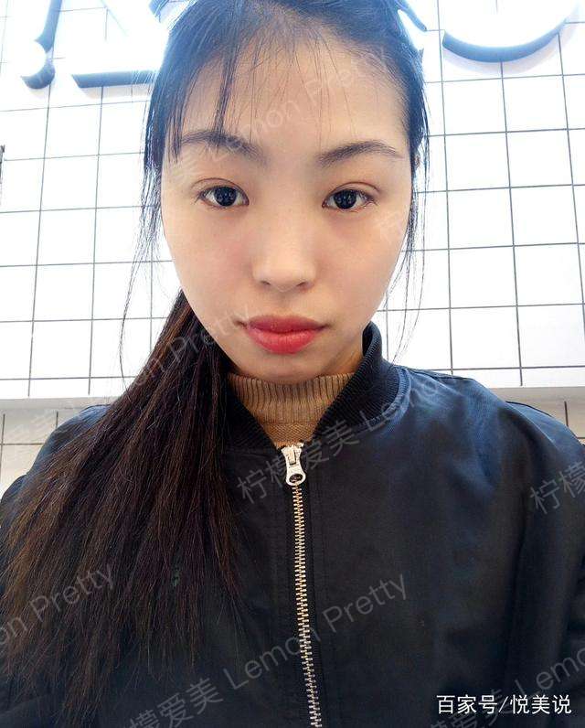 女实习生做的"全切双眼皮7mm",可惜不是平行扇形的……呜呜