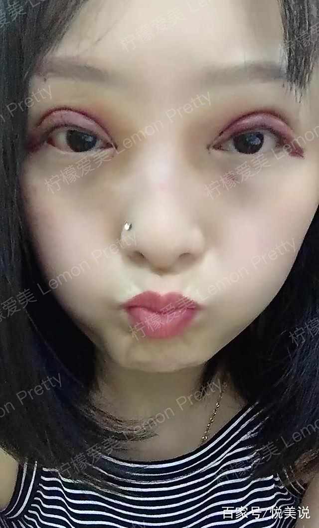 第4天看看这肿泡眼,四周淤青就像被打了一样,出去走路也是一瘸一拐的