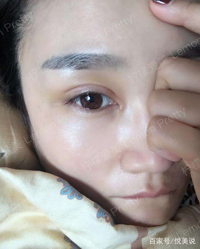 宝妈在宝宝7个月时就去做了"全切双眼皮7mm",感觉恢复的好慢