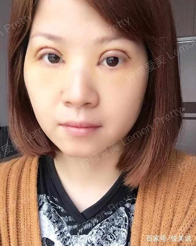 宝妈做"全切双眼皮7mm"2个月了,照片不美颜都不敢晒朋友圈