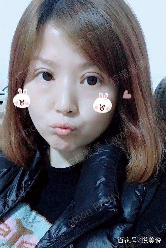 宝妈做"全切双眼皮7mm"2个月了,照片不美颜都不敢晒朋友圈
