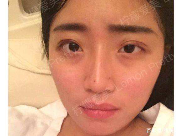 妹子做"埋线双眼皮"1个月后说:哈哈,我的大小眼基本消失了