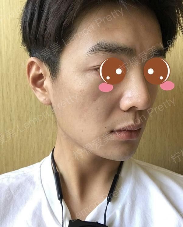 男主皮肤松弛,超声刀的美肤日志